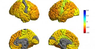 
<h3>Hallada una causa del trastorno bipolar</h3>
Una investigación revela el mal funcionamiento de una proteína en el cerebro en los pacientes de trastorno bipolar que responden al litio
PUBLICO | MALEN RUÍZ DE ELVIRA